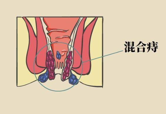 肛裂治療最新方法概述