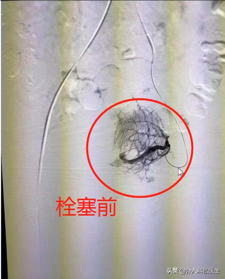 腺肌癥最新治療技術(shù)與方法探索